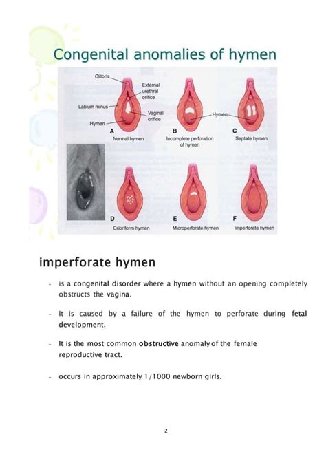 imperforate hymen|Imperforate hymen: Causes, Risk Factors, Symptoms, Treatment